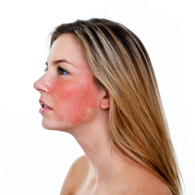 facial rosacea current trials clinical partners llc